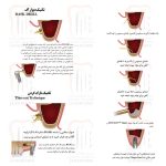 کیت پیشرفته سینوس لیفت اوپن و کلوز کاریزما - 15 عددی - Open & Close Sinus Lift