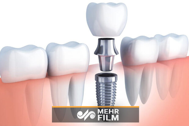 ایمپلنت دندان چگونه انجام می‌شود؟