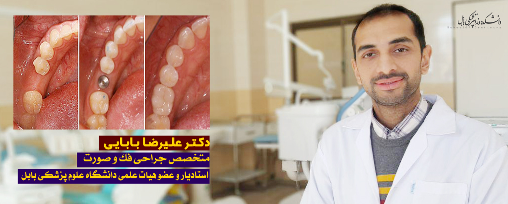دکتر بابایی: ایمپلنت های دندانی