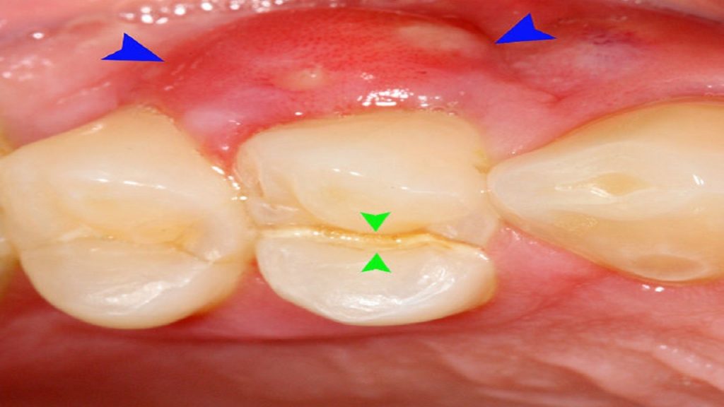 رایج‌ترین علائم آبسه دندان