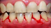 چگونه خونریزی دندان و لثه را متوقف کنیم؟‌