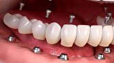چه زمانی ایمپلنت دندان دچار عفونت می‌شود؟