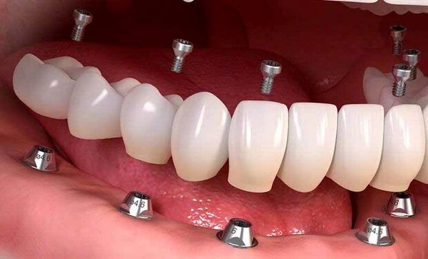 ایمپلنت دندان چیست؟

