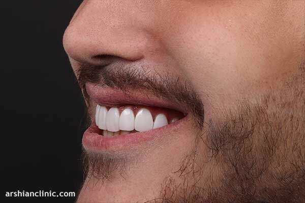 ۵ موردی که قبل از کامپوزیت دندان باید بدانید