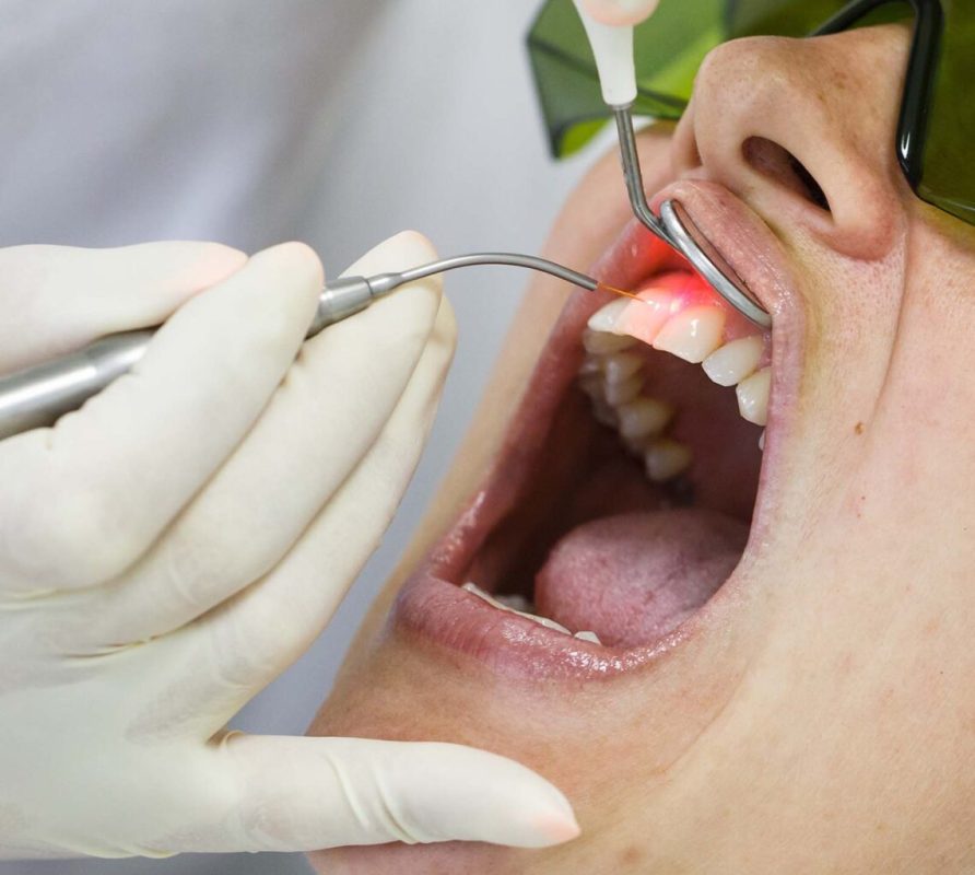 کاربردهای لیزر در دندانپزشکی