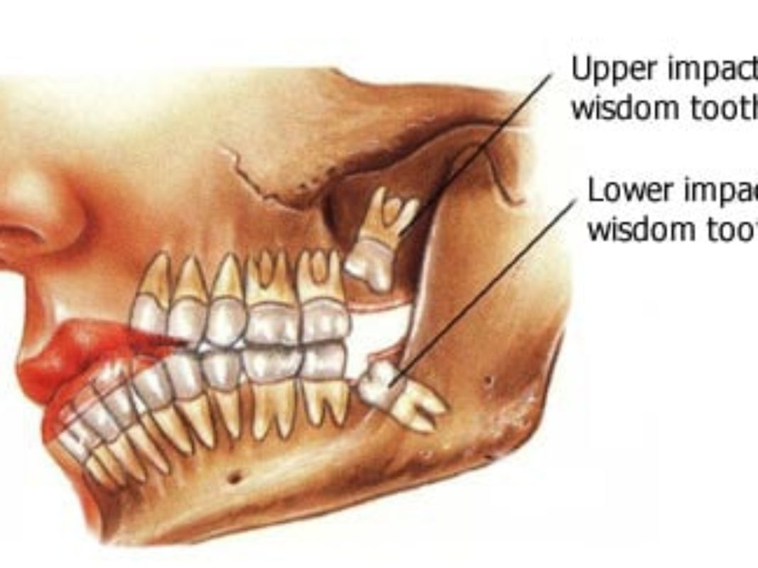عوارض به موقع نکشیدن دندان عقلی که نیاز به کشیدن دارد