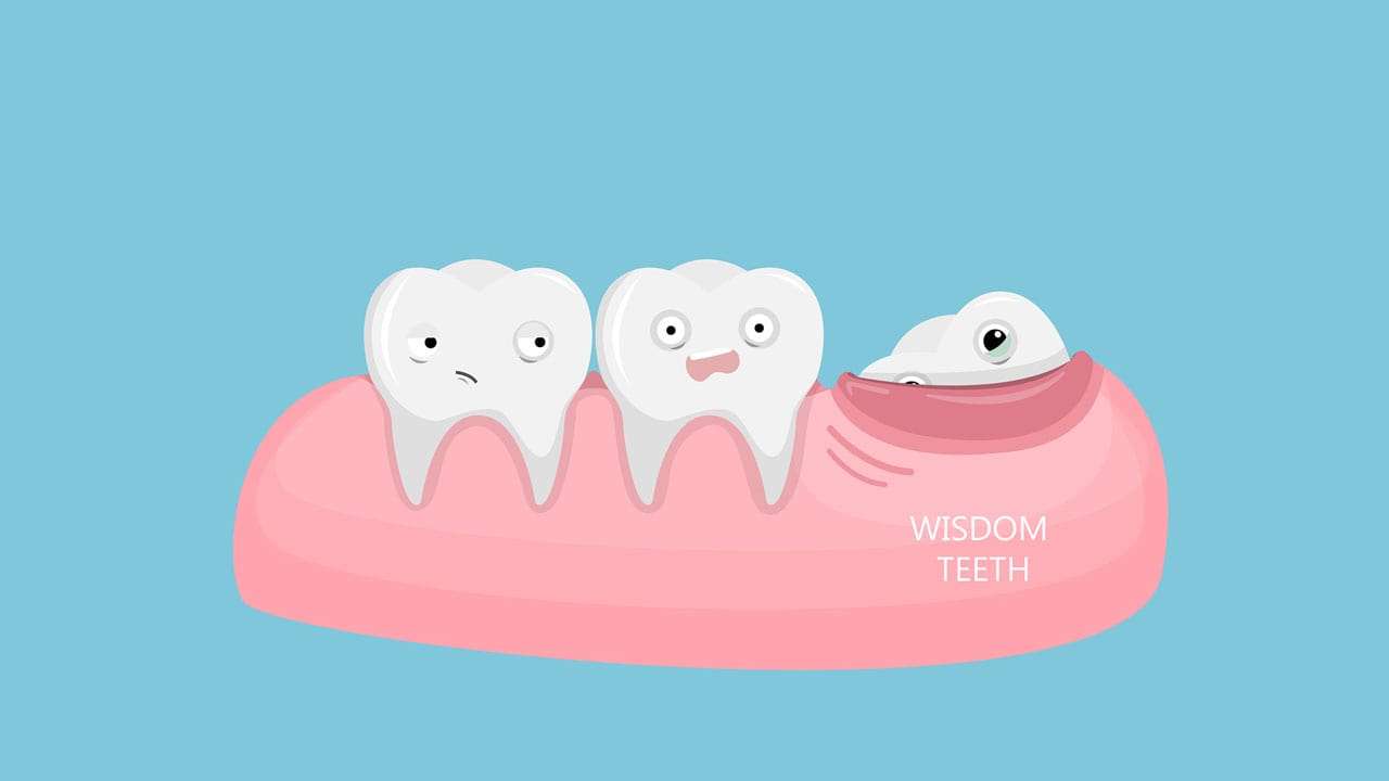 عوارض به موقع نکشیدن دندان عقلی که نیاز به کشیدن دارد